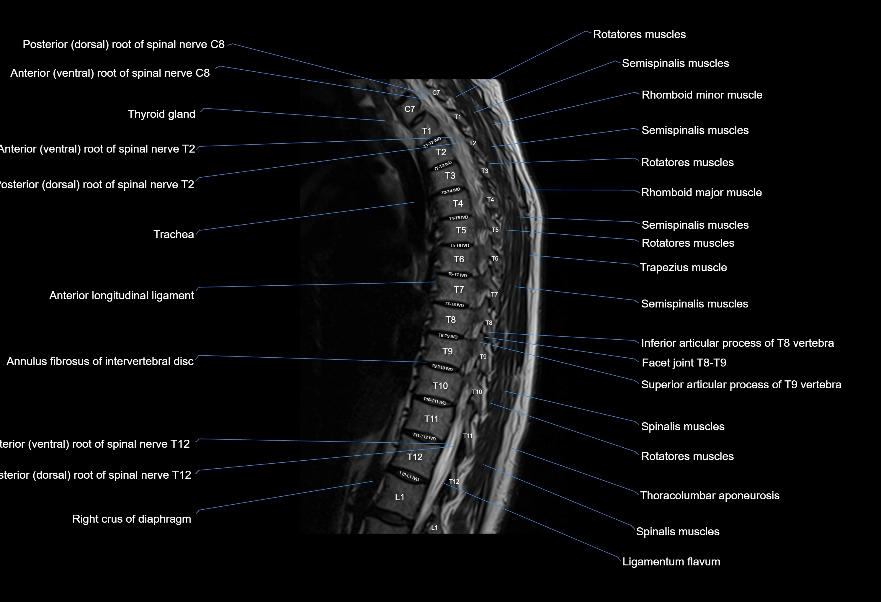 MRI thoracic spine sagittal  cross sectional anatomy 3T radiology  image-img-00001-00009.webp